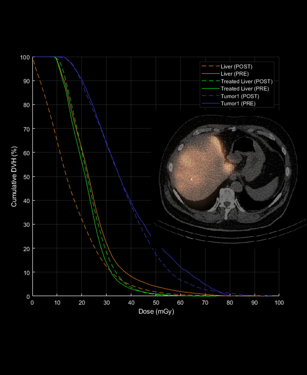 Advanced Molecular SIRT MAA/Y90 dosimetry