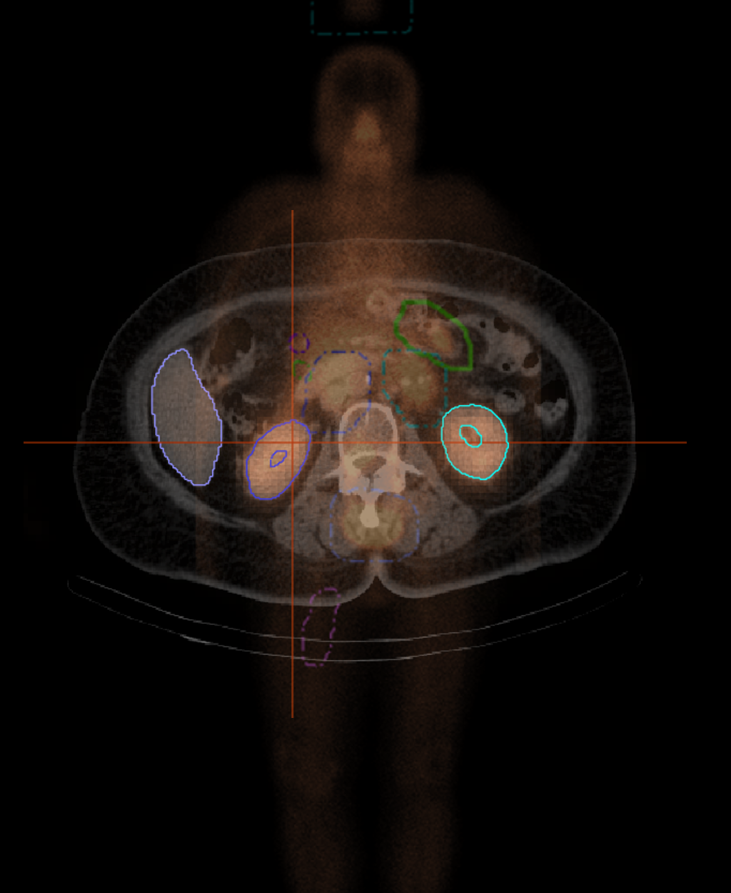 Advanced Molecular Imaging Hybrid dosimetry