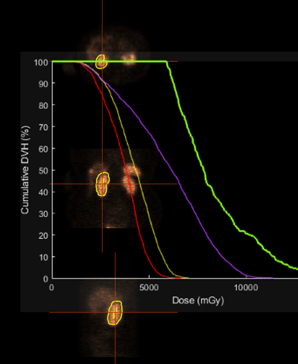 Advanced Molecular volumetric dosimetry with dose volume histograms